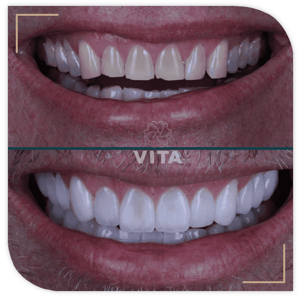 Resultado de lentes de contato dental em paciente da Clínica Vita Implantes, em Goiânia